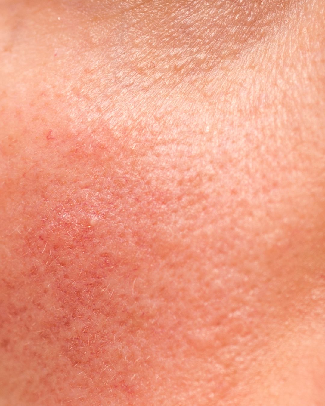 How to Know if Your Skin Barrier Is Damaged